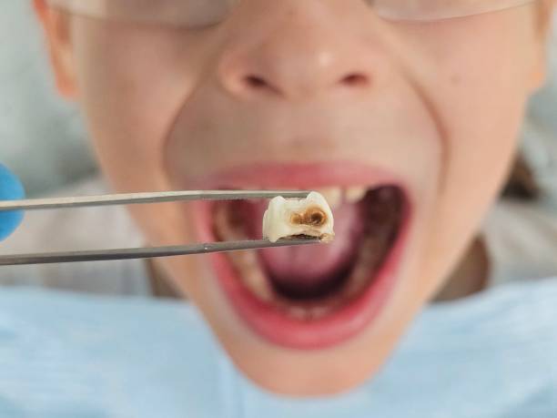 Best Emergency Dental Care for Broken or Chipped Teeth in Shenandoah, IA